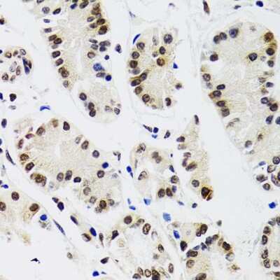 Immunohistochemistry-Paraffin: EDF1 Antibody [NBP2-92882] - Human gastric cancer using EDF1 antibody at dilution of 1:100 (40x lens).