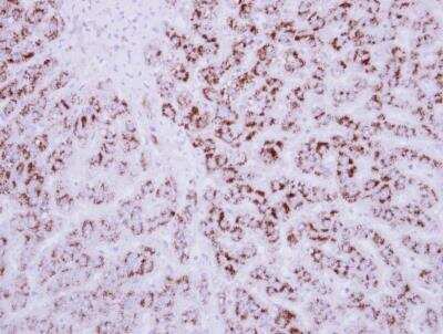 Immunohistochemistry-Paraffin: EDIL3/DEL1 Antibody [NBP2-16146] -  Human breast cancer, using EDIL3 antibody at 1:250 dilution.  Antigen Retrieval: Trilogy™ (EDTA based, pH 8.0) buffer, 15min. 