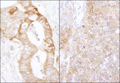 Immunohistochemistry-Paraffin: EEF2K Antibody [NB100-87019] - Section of human stomach carcinoma (left) and mouse teratoma (right). Antibody: Affinity purified rabbit anti-eEF2 Kinase used at a dilution of 1:1,000 (1ug/ml). Detection: DAB