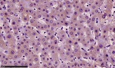 Immunohistochemistry-Paraffin: EGF Antibody [NBP1-19806] - Human hepatocellular carcinoma (HCC). Antibody at 1:100. Heat/citrate buffer antigen retrieval. Permeabilization with 2% Triton X-100. Counterstained with hematoxylin. IHC-P image submitted by a verified customer review.