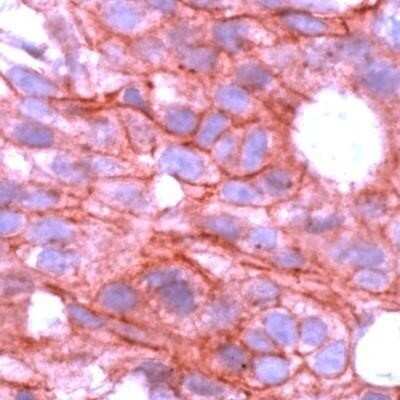 Immunohistochemistry-Paraffin: EGFR Antibody (29.1) [NB120-10414] - Human Breast Carcinoma