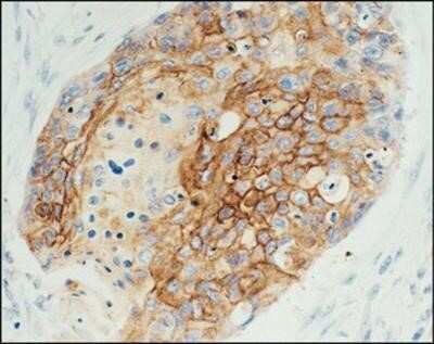 Immunohistochemistry-Paraffin: EGFR Antibody (29.1) [NB120-10414] - Lung carcinoma labeled with Monoclonal Anti-Epidermal Growth Factor Receptor. From R. Robinson, Univ. of Iowa, College of Med., Dept. of Pathology, Iowa City, IA.