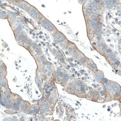 Immunohistochemistry-Paraffin: EGFR Antibody (CL0815) [NBP2-52952] - Staining of human ventricular cancer shows moderate membranous immunoreactivity in tumor cells.