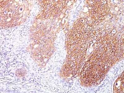 Immunohistochemistry-Paraffin: EGFR Antibody (GFR/1667) - Azide and BSA Free [NBP2-54310] - Formalin-fixed, paraffin-embedded human Lung SCC stained with EGFR Monoclonal Antibody (GFR/1667).