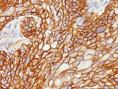 Immunohistochemistry-Paraffin: EGFR Antibody (GFR/1708) - Azide and BSA Free [NBP2-54330] - Formalin-fixed, paraffin-embedded human Lung SCC stained with EGFR Monoclonal Antibody (GFR/1708).