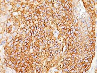 Immunohistochemistry-Paraffin: EGFR Antibody (GFR450) [NBP2-29440] - Formalin-fixed, paraffin-embedded squamous cell carcinoma stained with EGFR Ab (GFR450).