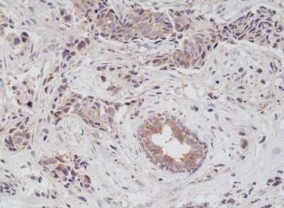 Immunohistochemistry-Paraffin: EGFR Antibody (RM294) [NBP2-61572] - Immunohistochemical staining of formalin fixed and paraffin embedded human breast cancer tissue sections using NBP2-61572.