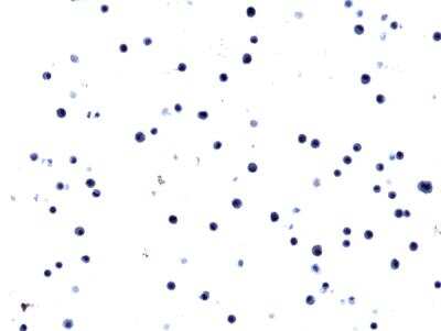 Immunohistochemistry-Paraffin: EGFR Antibody (RM380) - L858R [NBP2-89093] - Immunohistochemical staining of formalin fixed and paraffin embedded H1650 cell section using Anti-EGFR(L858R) Rabbit Monoclonal Antibody (Clone RM380) at a 1:100 dilution.