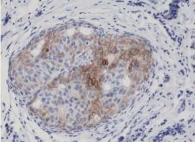 Immunohistochemistry-Paraffin: EGFR [p Tyr1173] Antibody (RM269) [NBP2-61528] - Immunohistochemical staining of formalin fixed and paraffin embedded Human breast cancer tissue sections using NBP2-61528.
