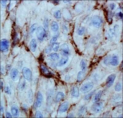 Immunohistochemistry: EGLN3/PHD3 Antibody (EG188e/d5) - Azide and BSA Free [NBP2-80715] - Analysis of HIF Prolyl Hydroxylase 3 in human renal cancer using DAB with hematoxylin counterstain. Image from the standard format of this antibody.