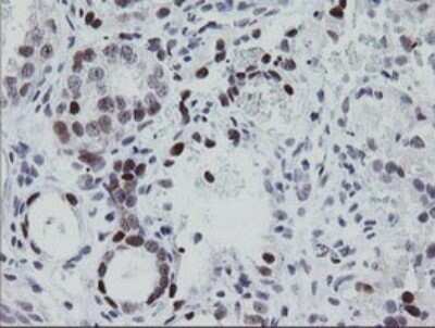Immunohistochemistry: EGR2 Antibody (OTI1B12) - Azide and BSA Free [NBP2-70624] - Analysis of Adenocarcinoma of Human ovary tissue. (Heat-induced epitope retrieval by 10mM citric buffer, pH6.0, 120C for 3min)