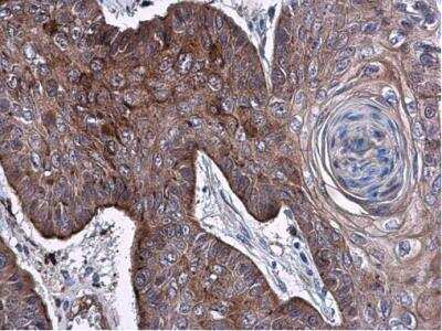 Immunohistochemistry-Paraffin: ELA3A Antibody [NBP2-14946] - Paraffin-embedded human esophagus carcinoma. ELA3A antibody diluted at 1:500.