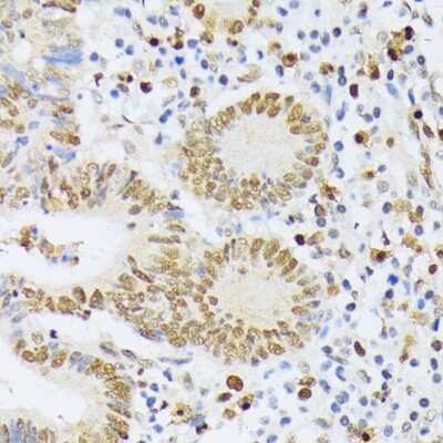 Immunohistochemistry-Paraffin: ELAC2 Antibody [NBP3-04612] - Paraffin-embedded human colon carcinoma using ELAC2 antibody at dilution of 1:200 (40x lens).