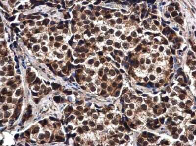 Immunohistochemistry-Paraffin: ELAC2 Antibody [NBP3-12934] - ELAC2 antibody detects ELAC2 protein at cytoplasm and nucleus in human breast carcinoma by immunohistochemical analysis. Sample: Paraffin-embedded human breast carcinoma. ELAC2 antibody (NBP3-12934) diluted at 1:500. Antigen Retrieval: Citrate buffer, pH 6.0, 15 min