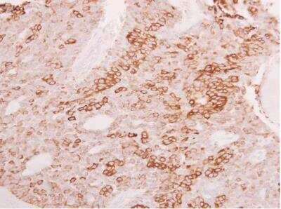 Immunohistochemistry-Paraffin: ELF3/ESE-1 Antibody [NBP1-30873] -  Human lung carcinoma. ESE1 antibody [C2C3], C-term diluted at 1:500. Antigen Retrieval: Trilogy™ (EDTA based, pH 8.0) buffer, 15min. 