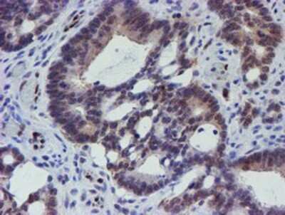 Immunohistochemistry: ELK3 Antibody (OTI1H3) - Azide and BSA Free [NBP2-70643] - Staining of paraffin-embedded Adenocarcinoma of Human colon tissue using anti-ELK3 mouse monoclonal antibody.