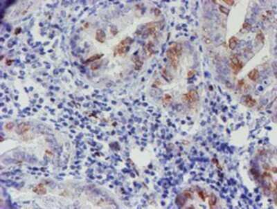 Immunohistochemistry: ELK3 Antibody (OTI1H3) - Azide and BSA Free [NBP2-70643] - Staining of paraffin-embedded Adenocarcinoma of Human endometrium tissue using anti-ELK3 mouse monoclonal antibody.