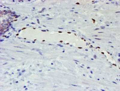 Immunohistochemistry: ELK3 Antibody (OTI1H3) - Azide and BSA Free [NBP2-70643] - Staining of paraffin-embedded Carcinoma of Human prostate tissue using anti-ELK3 mouse monoclonal antibody.