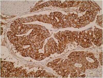 Immunohistochemistry: ELOVL3 Antibody (V61 P2B3-D10) [NBP2-50385] - Staining of human colorectal cancer tissue shows strong cytoplasmic positivity. IHC was performed on formalin-fixed, paraffin-embedded tissue sections