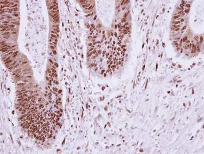 Immunohistochemistry-Paraffin: ELP2 Antibody [NBP2-16321] - Analysis of paraffin-embedded human colon carcinoma, using ELP2 antibody at 1:250 dilution. Antigen Retrieval: Trilogy™ (EDTA based, pH 8.0) buffer, 15min