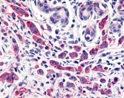 Immunohistochemistry-Paraffin: ELTD1/ETL Antibody [NLS2116] - Analysis of anti-ELTD1 antibody with human breast, carcinoma.