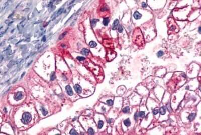 Immunohistochemistry-Paraffin: ELTD1/ETL Antibody [NLS2116] - Anti-ELTD1 antibody IHC of human Ovary, Carcinoma. Immunohistochemistry of formalin-fixed, paraffin-embedded tissue after heat-induced antigen retrieval.