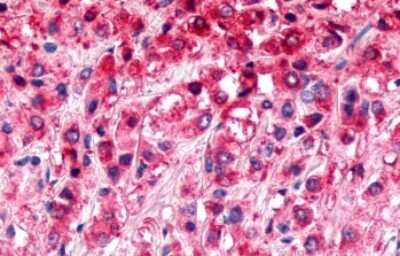 Immunohistochemistry-Paraffin: ELTD1/ETL Antibody [NLS2116] - Anti-ELTD1 antibody IHC of human Prostate, Carcinoma. Immunohistochemistry of formalin-fixed, paraffin-embedded tissue after heat-induced antigen retrieval.