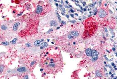 Immunohistochemistry-Paraffin: ELTD1/ETL Antibody [NLS2116] - Lung, Non Small-Cell Carcinoma