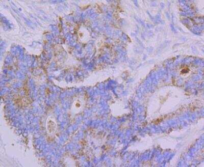 Immunohistochemistry: EMI1 Antibody (JG35-83) [NBP2-76833] - Immunohistochemical analysis of paraffin-embedded human colon cancer tissue using anti-Emi1 antibody. Counter stained with hematoxylin.