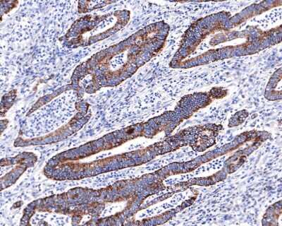 Immunohistochemistry-Paraffin: EMI1 Antibody (JG35-83) [NBP2-76833] - Analysis of paraffin-embedded human colon carcinoma with Rabbit anti-EMI1 antibody washed with ddH2O and PBS, and then probed with the primary antibody at 1/400 dilution for 1 hour at room temperature. The detection was performed using an HRP conjugated compact polymer system. DAB was used as the chromogen. Tissues were counterstained with hematoxylin and mounted with DPX.
