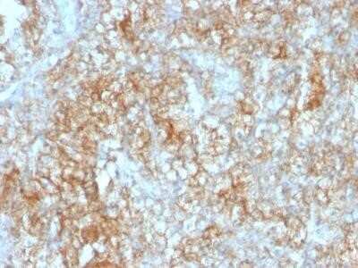 Immunohistochemistry-Paraffin: EMMPRIN/CD147 Antibody (8D6) - IHC-Prediluted [NBP2-44535] - Formalin-fixed, paraffin-embedded human Renal Cell Carcinoma stained with CD147 Monoclonal Antibody (8D6).