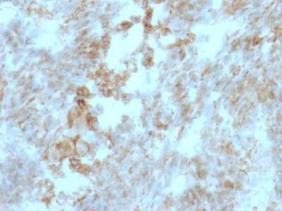 Immunohistochemistry-Paraffin: EMMPRIN/CD147 Antibody (BSG/963) [NBP2-44537] - Human Colon Carcinoma stained with CD147 Monoclonal Antibody (BSG/963).