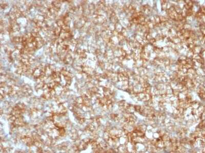 Immunohistochemistry-Paraffin: EMMPRIN/CD147 Antibody (BSG/963) [NBP2-44537] - Human Renal Cell Carcinoma stained with CD147 Monoclonal Antibody (BSG/963).