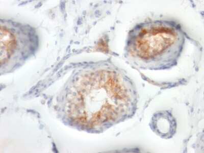 Immunohistochemistry-Paraffin: EMMPRIN/CD147 Antibody (BSG/963) [NBP2-44537] - Human Testicular Carcinoma stained with CD147 Monoclonal Antibody (BSG/963).