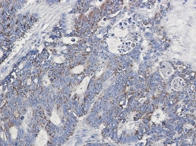 Immunohistochemistry-Paraffin: EMMPRIN/CD147 Antibody (S04-5B3) [NBP3-20062] - Immunohistochemistry of EMMPRIN/CD147 in paraffin-embedded Human colon cancer tissue using NBP3-20062 at dilution 1/50