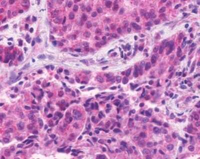 Immunohistochemistry-Paraffin: EMR1 Antibody [NLS1180] - Analysis of anti-EMR1 / F4/80 antibody with human lung, adenocarcinoma.