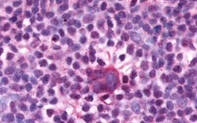 Immunohistochemistry-Paraffin: EMR1 Antibody [NLS1180] - Anti-EMR1 / F4/80 antibody IHC of human Lymph Node, Hodgkins Lymphoma. Immunohistochemistry of formalin-fixed, paraffin-embedded tissue after heat-induced antigen retrieval.