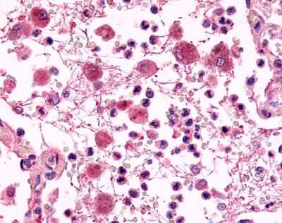 Immunohistochemistry-Paraffin: EMR2 Antibody [NLS6381] - Analysis of anti-EMR2 antibody with human lung, pneumonia, neutrophils at 14 ug/ml.