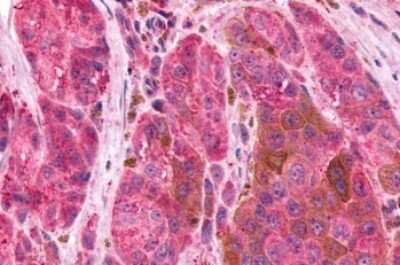 Immunohistochemistry-Paraffin: EMR2 Antibody [NLS6381] - Anti-EMR2 antibody IHC of human Skin, Melanoma. Immunohistochemistry of formalin-fixed, paraffin-embedded tissue after heat-induced antigen retrieval.