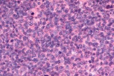 Immunohistochemistry-Paraffin: EMR2 Antibody [NLS6381] - Anti-EMR2 antibody IHC of human Lymph Node, Non-Hodgkins Lymphoma. Immunohistochemistry of formalin-fixed, paraffin-embedded tissue after heat-induced antigen retrieval.