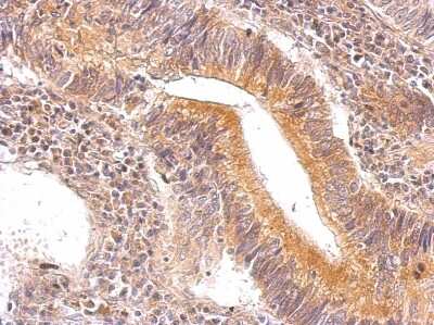 Immunohistochemistry-Paraffin: ENO3 Antibody [NBP1-31764] - Paraffin-embedded gastric carcinoma; antibody dilution 1:500.