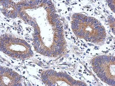 Immunohistochemistry-Paraffin: ENTPD7 Antibody [NBP2-16343] - Immunohistochemical analysis of paraffin-embedded Colon ca, using antibody at 1:500 dilution.