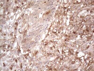 Immunohistochemistry: EPCR Antibody (OTI12H5) - Azide and BSA Free [NBP2-71607] - Analysis of Adenocarcinoma of Human colon tissue. (Heat-induced epitope retrieval by 1mM EDTA in 10mM Tris buffer (pH8.5) at 120C for 3 min)