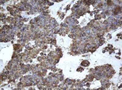 Immunohistochemistry: EPHX1 Antibody (3F10) [NBP2-45478] - Analysis of Carcinoma of Human pancreas tissue.