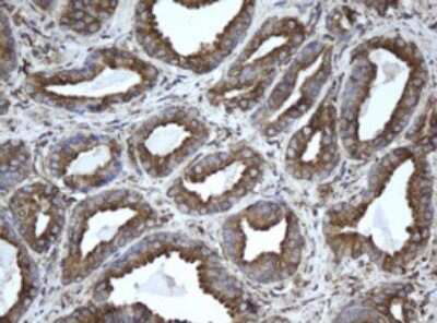 Immunohistochemistry: EPHX1 Antibody (3F10) [NBP2-45478] - Analysis of Carcinoma of Human prostate tissue.