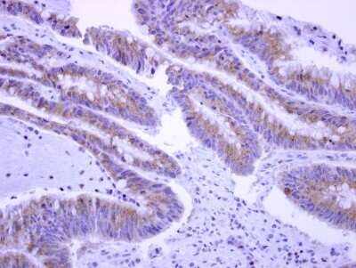 Immunohistochemistry-Paraffin: EPS8L2 Antibody [NBP2-16357] - Immunohistochemical analysis of paraffin-embedded Colon carcinoma, using antibody at 1:500 dilution.