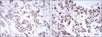 Immunohistochemistry-Paraffin: ER alpha/NR3A1 Antibody (6B6) [NBP1-51653] - Immunohistochemical analysis of paraffin-embedded mammary cancer tissues using ESR1 mouse mAb with DAB staining.