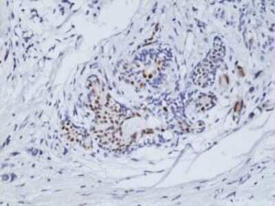 Immunohistochemistry: ER alpha/NR3A1 Antibody (RM292) [NBP2-61467] - Immunohistochemical staining of formalin fixed and paraffin embedded human breast cancer tissue sections using NBP2-61467.
