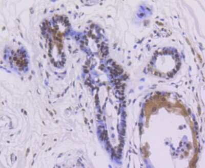 Immunohistochemistry-Paraffin: ER alpha/NR3A1 [p Ser118] Antibody (SC05-87) [NBP2-67575] - Analysis of paraffin-embedded human breast carcinoma tissue using anti- phospho-Estrogen Receptor alpha(S118) antibody. Counter stained with hematoxylin.