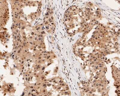 Immunohistochemistry-Paraffin: ER alpha/NR3A1 [p Ser118] Antibody (SC05-87) [NBP2-67575] - Immunohistochemical analysis of paraffin-embedded human breast carcinoma tissue using anti-ER alpha/NR3A1 antibody. The section was pre-treated using heat mediated antigen retrieval with Tris-EDTA buffer (pH 8.0-8.4) for 20 minutes. The tissues were blocked in 5% BSA for 30 minutes at room temperature, washed with ddH2O and PBS, and then probed with the primary antibody (ET1610-32, 1/50) for 30 minutes at room temperature. The detection was performed using an HRP conjugated compact polymer system. DAB was used as the chromogen. Tissues were counterstained with hematoxylin and mounted with DPX.